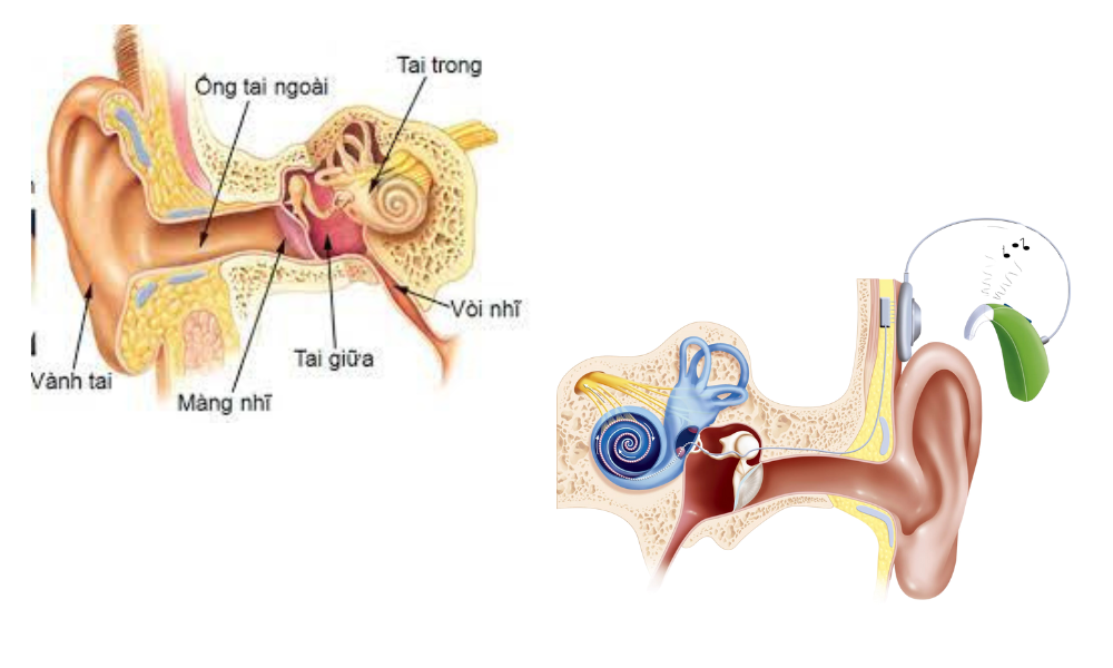 Suy giảm thính lực và phương pháp cấy ốc tai