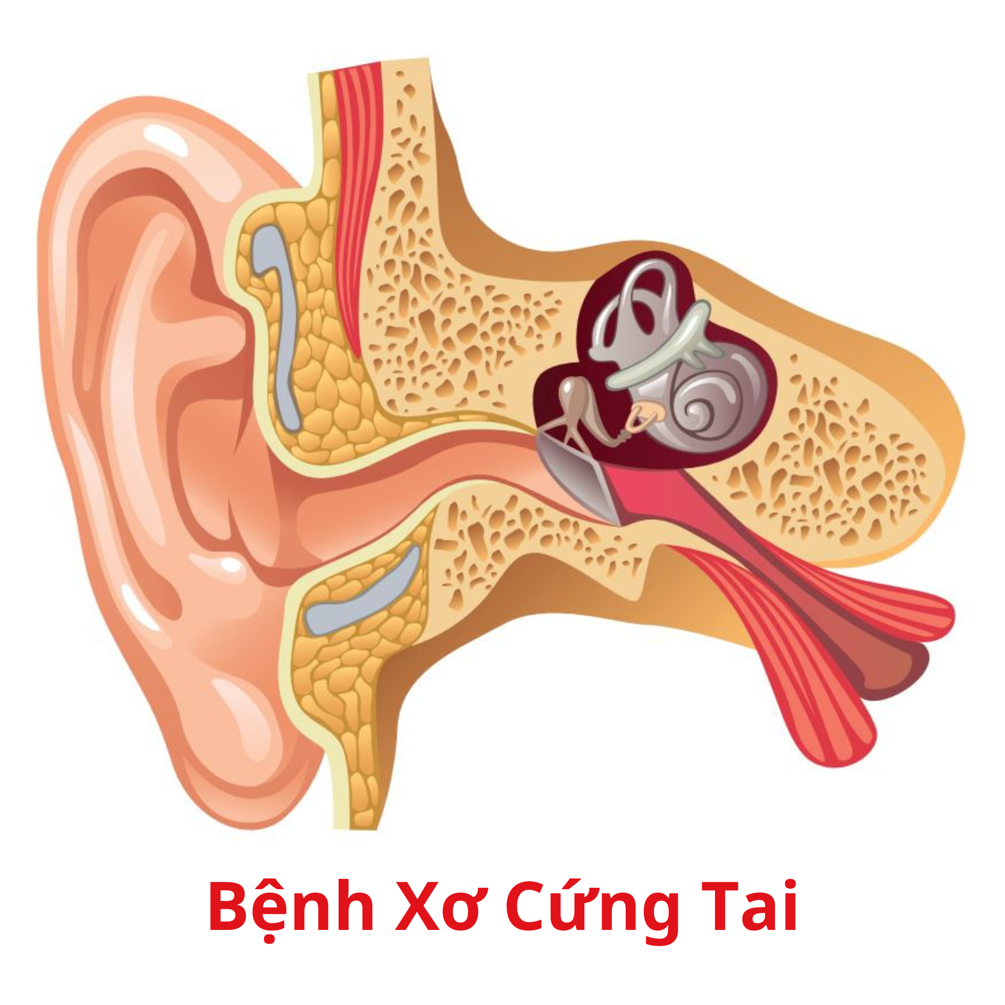 Mất thính lực - Bệnh xơ cứng tai